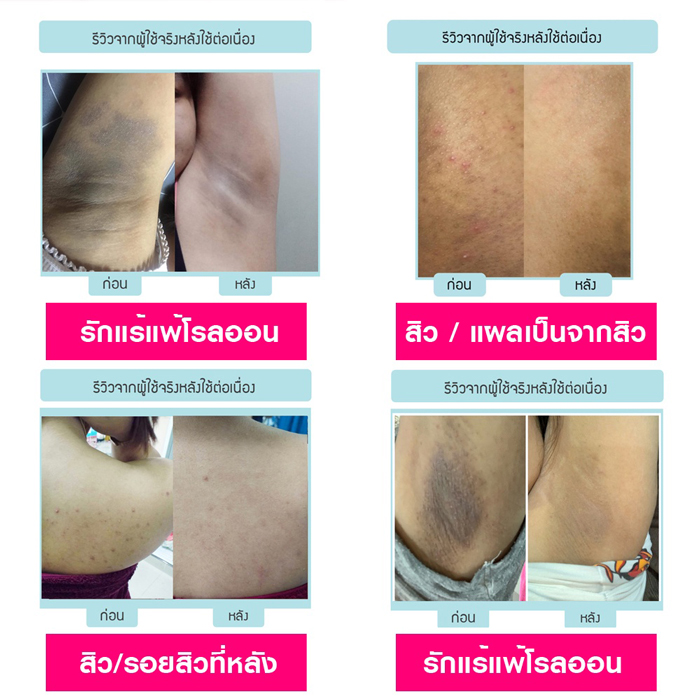 ครีมบำรุงผิวบริเวณบั้นท้าย Nakiz Lively Butt